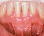 After placement of a gum graft, adequate attached gingiva to prevent further bone/tissue loss.