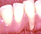 Recession with no attached gum. Without treatment, the recession will continue. The root is difficult to clean, leading to plaque formation and inflammation.