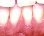 After placement of new<br />
attached gum.
