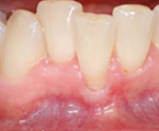 Recession with a lack of attached gingiva.