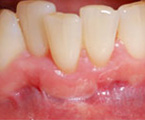 Gum graft placed, resulting in adequate attached gingiva and health. The root is not covered.