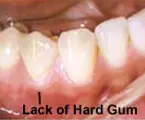 Insufficient attached gum<br />
results in recession starting