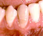 Insufficient attached gum<br />
without treament results in continued loss of gum and bone