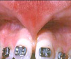 High frenum with lack of attached gum causing muscle pull and tooth separation.