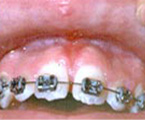 After frenum removal, and<br />
addition of adequate attached gingiva