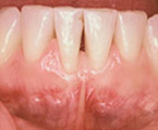 Recession associated with a lack of attached gingiva. The bone has also receded. Untreated, this may result in tooth loss.