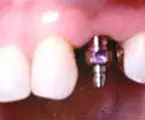 Implant and carrier in place