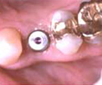 Healing cap screwed into implant,<br />
to keep gum from closing over implant during healing
