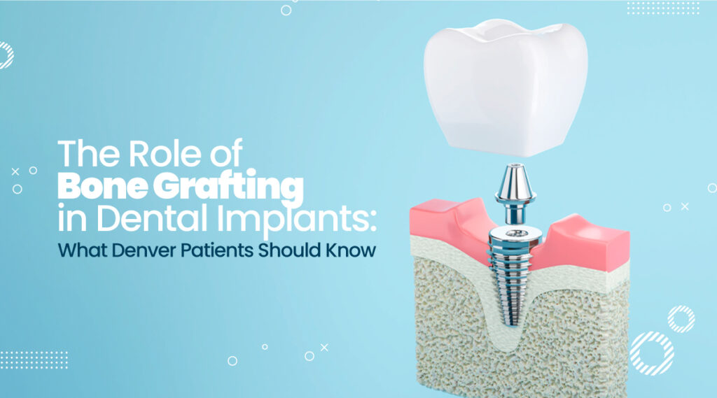 The Role of Bone Grafting in Dental Implants - Denver Dental Implants