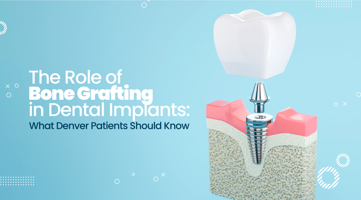 The Role of Bone Grafting in Dental Implants: What Denver Patients Should Know