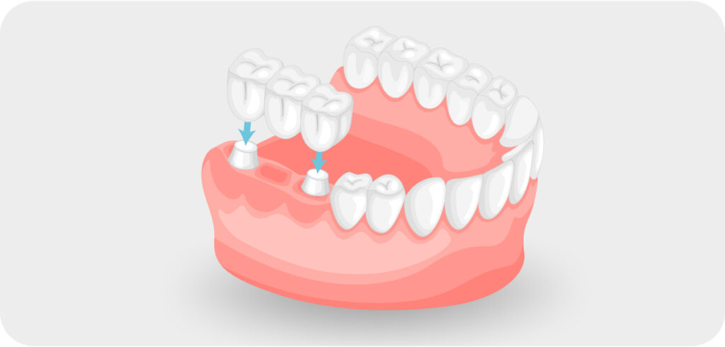 Dental Bridges - Denver Dentists