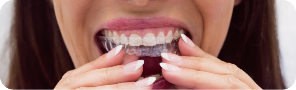 Maintain Your Smile After Treatment